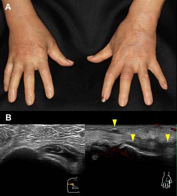 Case Report: Resolution of remitting seronegative symmetrical synovitis with pitting edema during nivolumab therapy for gastric cancer